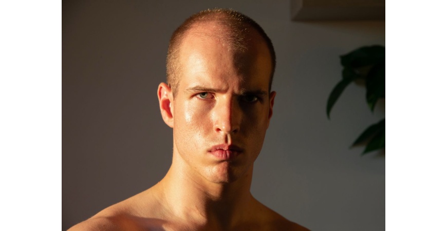 Alopecia androgenética: qué es y cómo detectarla 
