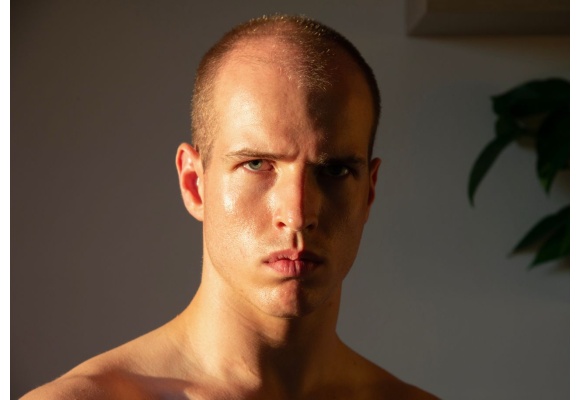 Alopecia androgenética: qué es y cómo detectarla 